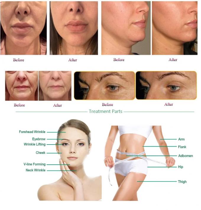 고강도 집중 초음파 비수술 얼굴 및 신체 치료 3D 히푸 기계 피부 리프팅 및 표적 지방 감소 5