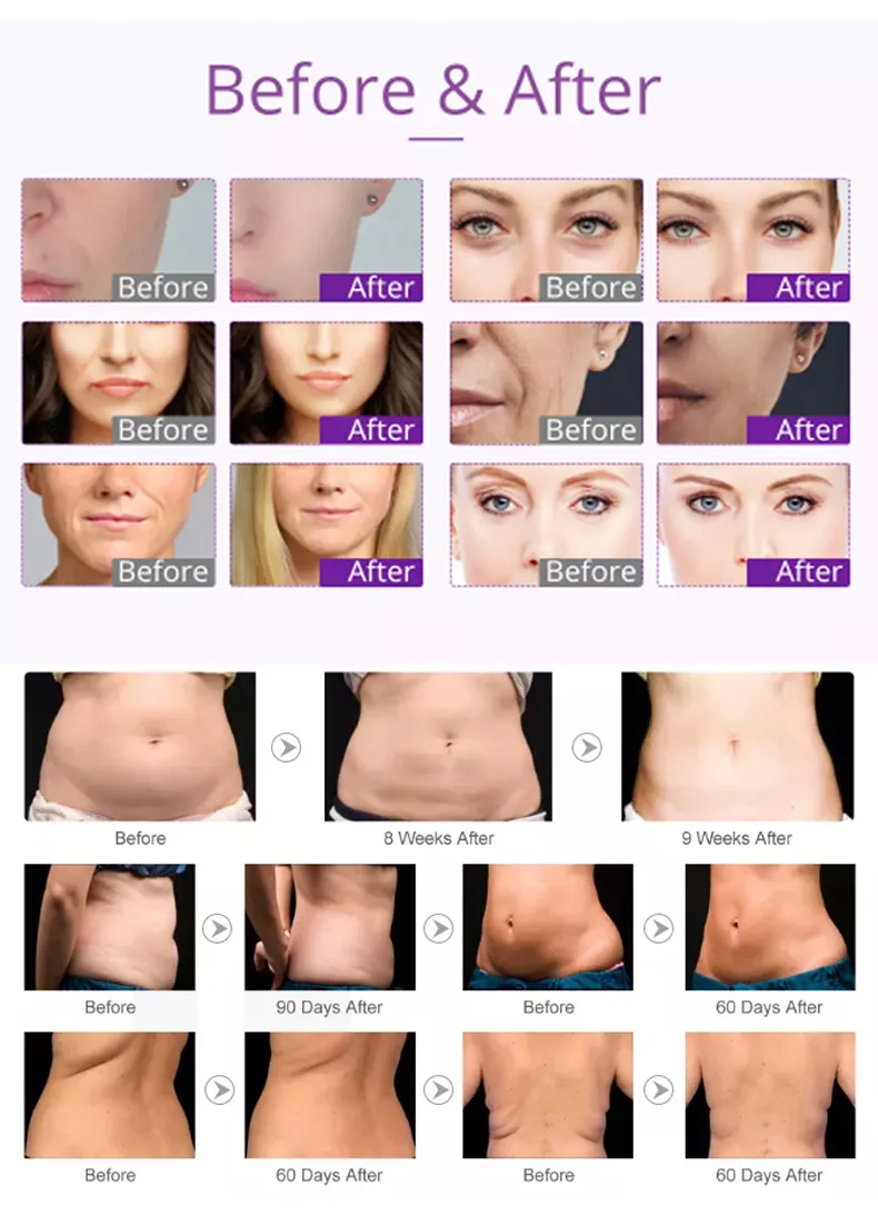 6 In 1 Body Slimming Machine RF Ultrasonic Cavitation Machine 40k 7
