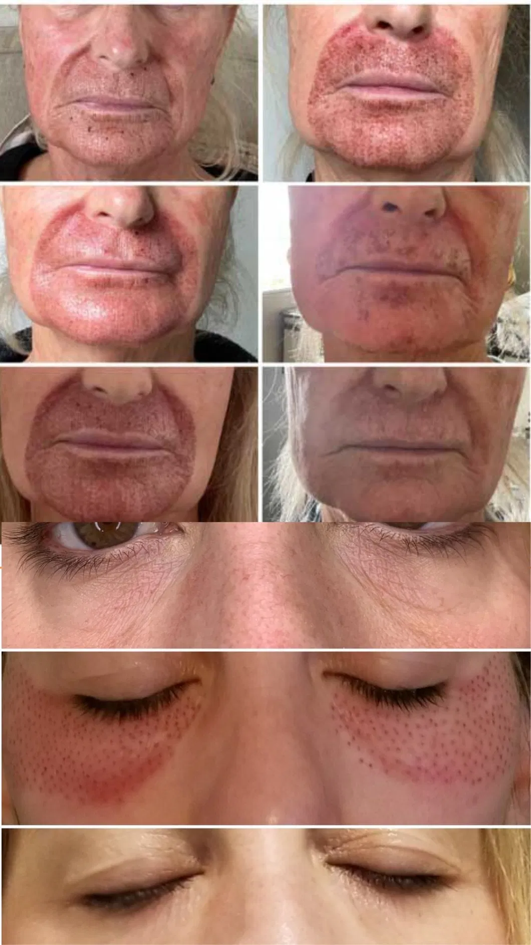 Professional Cold Plasma Skin Rejuvenation Machine for Face and Body 3